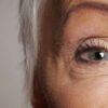 Blepharoplasty – Full Eyelid Removal