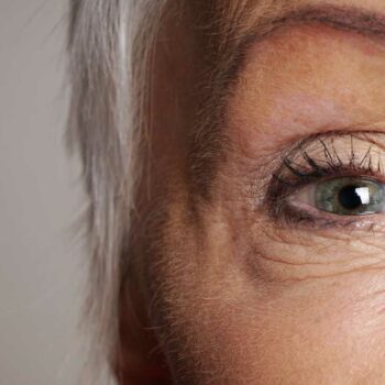 Blepharoplasty – Full Eyelid Removal