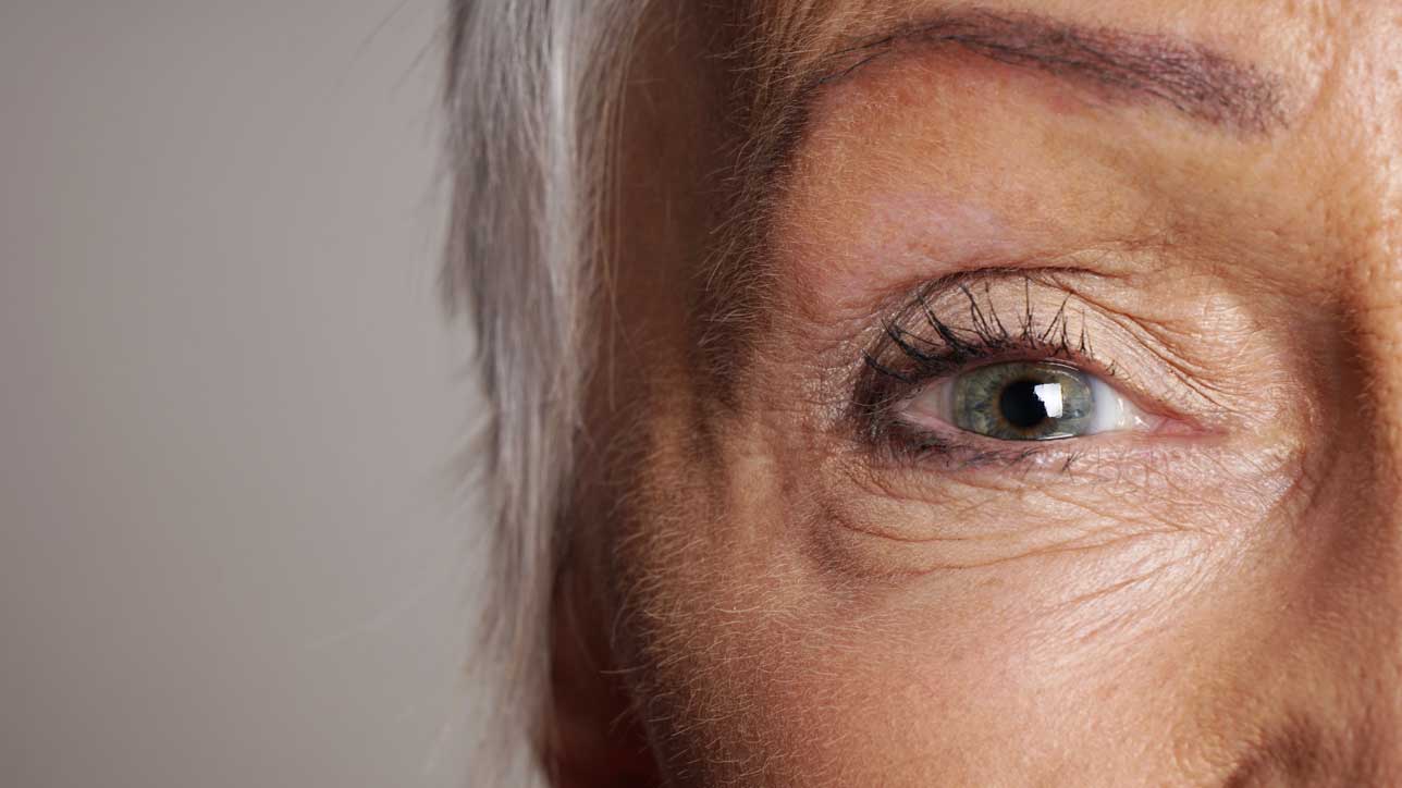 Blepharoplasty – Full Eyelid Removal