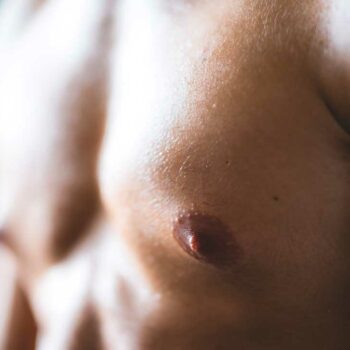 Gynecomastia