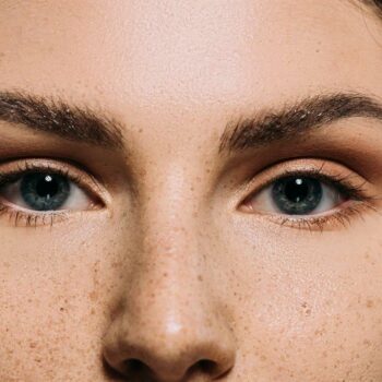 Canthoplasty – Cat Eye