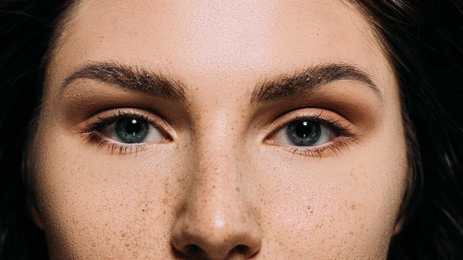 Canthoplasty – Cat Eye