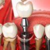 Implant Dentistry