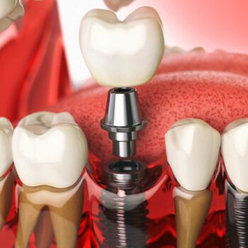 Implant Dentistry