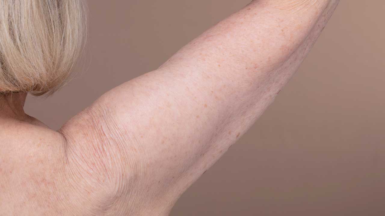 Arm Lift Surgery