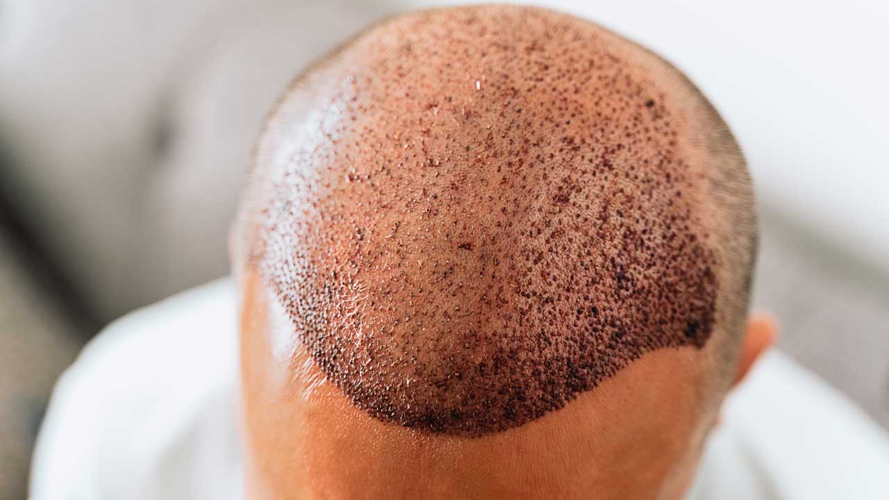 Hair Transplant in Turkey