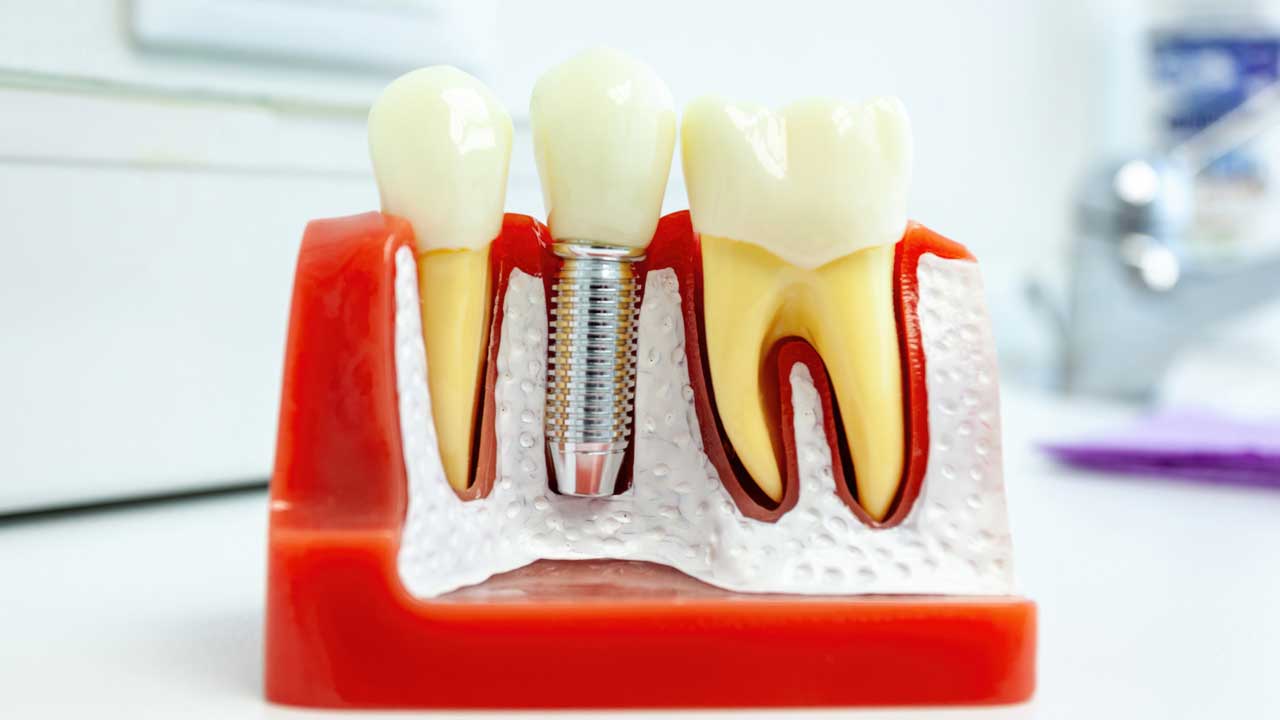 Dental Implant