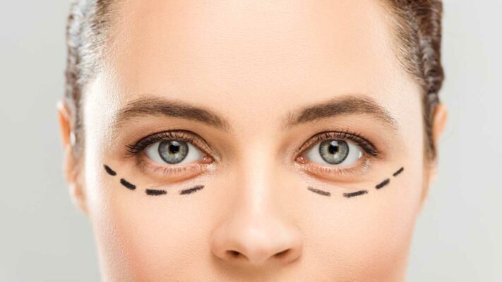 Lower Eyelid Removal