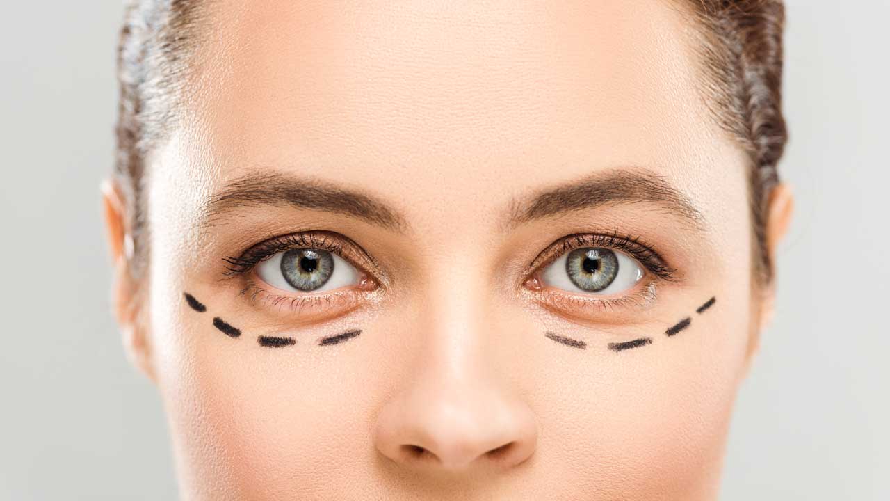 Lower Eyelid Removal
